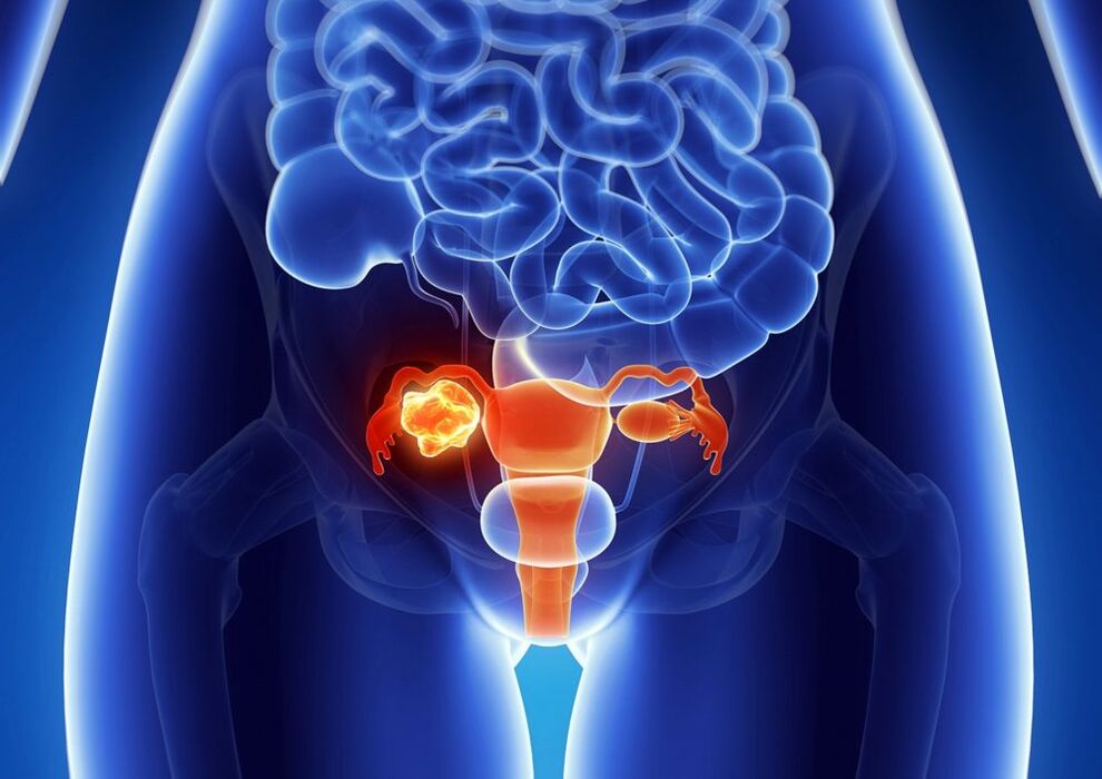 The pathology of the ovaries of the woman under the influence of alcohol